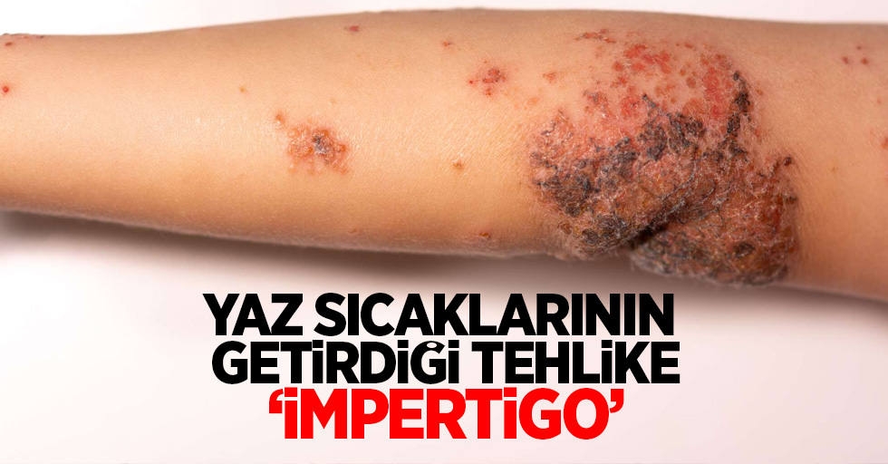 Yaz sıcaklarının getirdiği tehlike ‘impertigo’